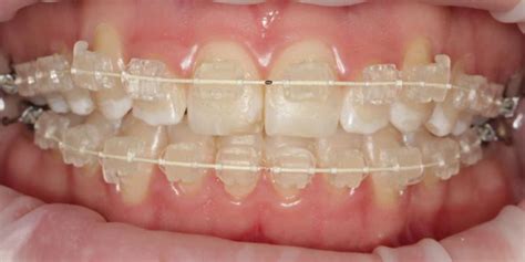 Exeter orthodontics - For more information on this or any other treatment please call 01392 202 007. Call us. There are a number of teeth straightening options available to you at Exeter Advanced Dentistry. Find out more about our orthodontics. 